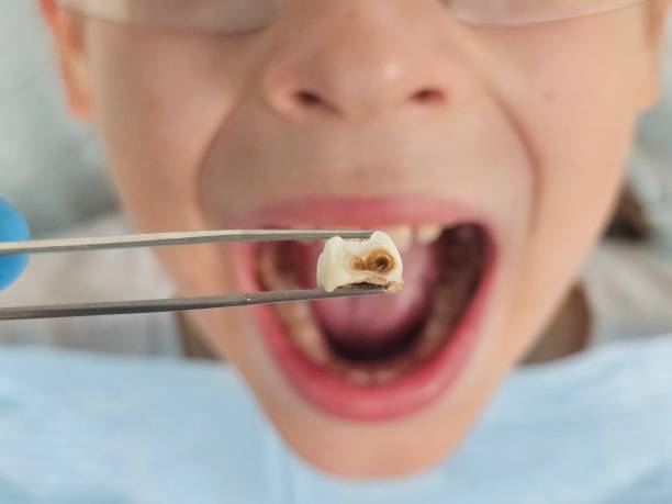 Best Dental Abscess Treatment in Berkeley Lake, GA
