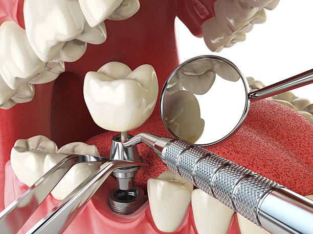 Best Emergency Root Canal Therapy in Berkeley Lake, GA